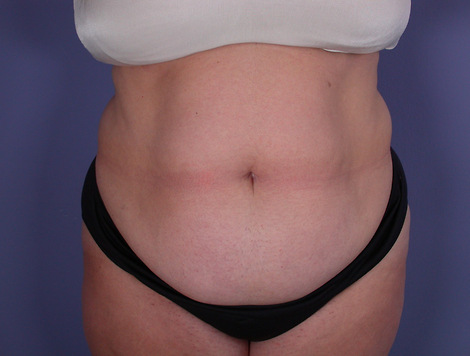 Tummy Tuck before and after photo