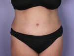 Tummy Tuck Before and after photo