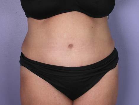 Tummy Tuck before and after photo