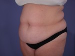 Tummy Tuck