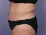 Tummy Tuck Before and after photo