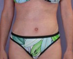 Tummy Tuck Before and after photo