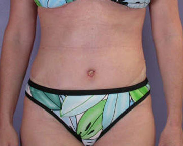 Tummy Tuck before and after photo