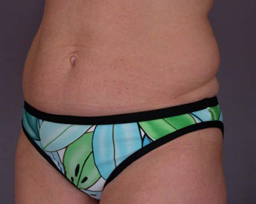 Tummy Tuck before and after photo