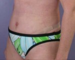 Tummy Tuck Before and after photo