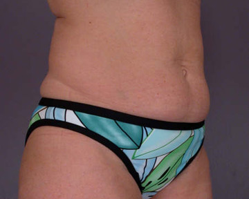 Tummy Tuck before and after photo