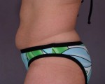 Tummy Tuck Before and after photo