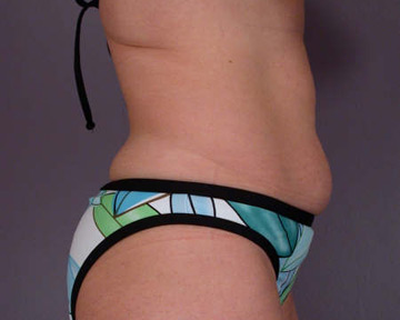 Tummy Tuck before and after photo