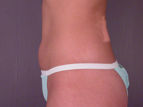 Tummy Tuck before and after photo