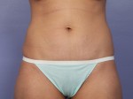 Tummy Tuck Before and after photo