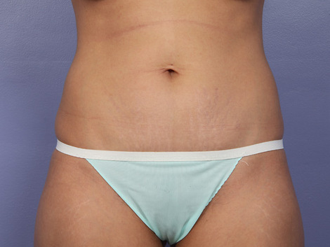 Tummy Tuck before and after photo