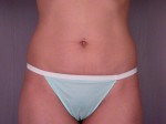 Tummy Tuck Before and after photo