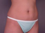 Tummy Tuck Before and after photo