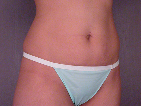 Tummy Tuck before and after photo