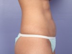 Tummy Tuck Before and after photo