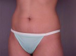 Tummy Tuck Before and after photo