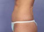 Tummy Tuck Before and after photo