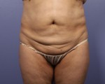 Tummy Tuck Before and after photo