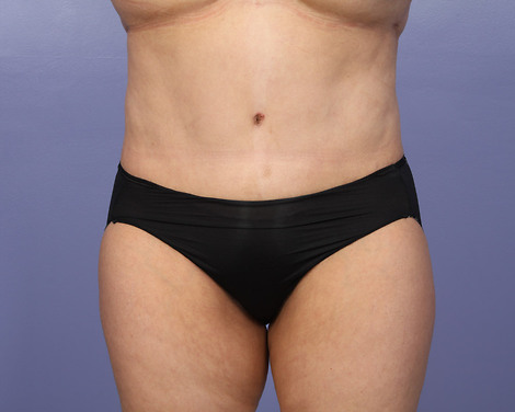 Tummy Tuck before and after photo