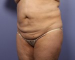 Tummy Tuck Before and after photo