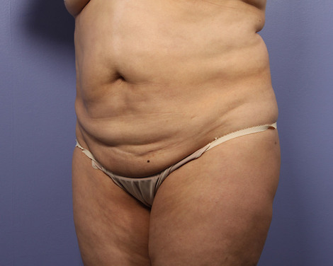 Tummy Tuck before and after photo