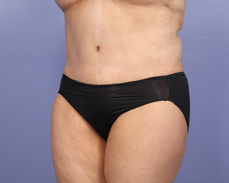 Tummy Tuck before and after photo