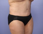 Tummy Tuck Before and after photo