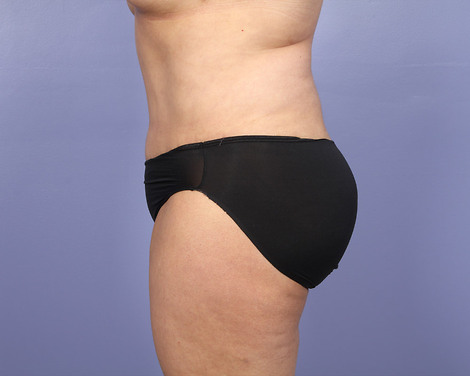 Tummy Tuck before and after photo