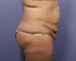 Tummy Tuck Before and after photo