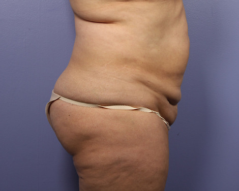 Tummy Tuck before and after photo