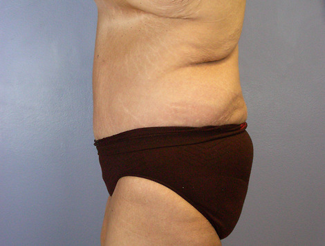 Tummy Tuck before and after photo