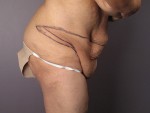 Tummy Tuck Before and after photo