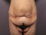 Tummy Tuck Before and after photo