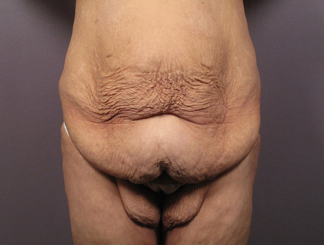 Tummy Tuck before and after photo