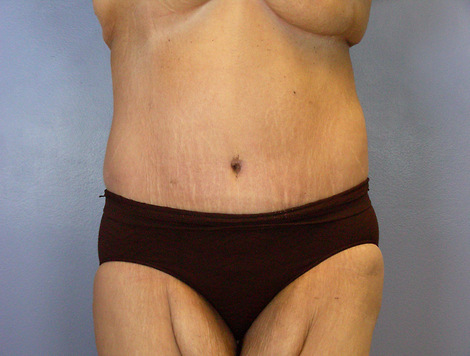 Tummy Tuck before and after photo