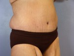 Tummy Tuck Before and after photo