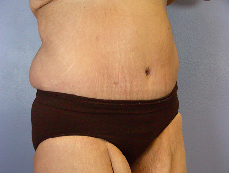 Tummy Tuck before and after photo