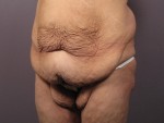 Tummy Tuck Before and after photo