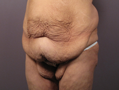 Tummy Tuck before and after photo