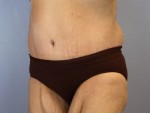 Tummy Tuck Before and after photo