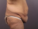 Tummy Tuck Before and after photo