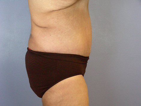 Tummy Tuck before and after photo