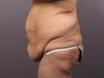 Tummy Tuck Before and after photo