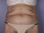 Tummy Tuck Before and after photo