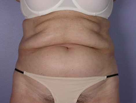 Tummy Tuck before and after photo