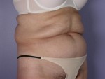 Tummy Tuck Before and after photo