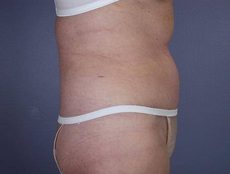 Tummy Tuck before and after photo