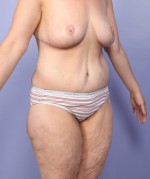 Tummy Tuck Before and after photo