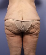 Tummy Tuck Before and after photo