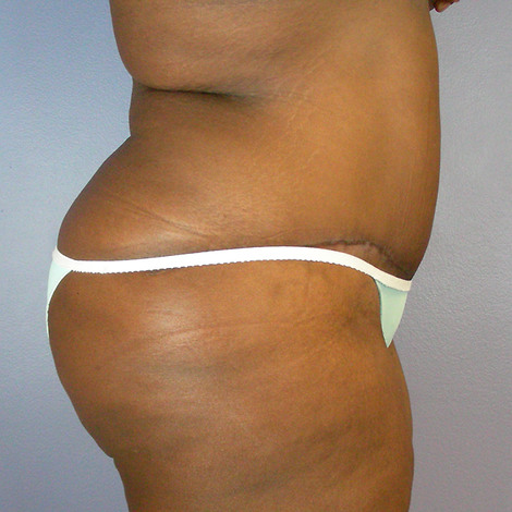 Tummy Tuck before and after photo